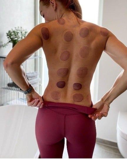 Cupping_massage-Randers.jpg.